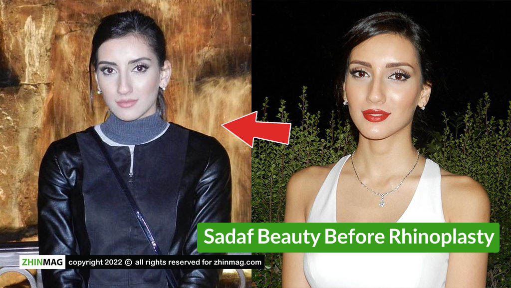sadaf beauty Rhinoplasty Before and After Photos